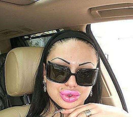 عکس لب پروتز زشت