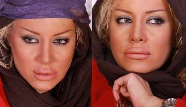 عکس لب پروتز زشت