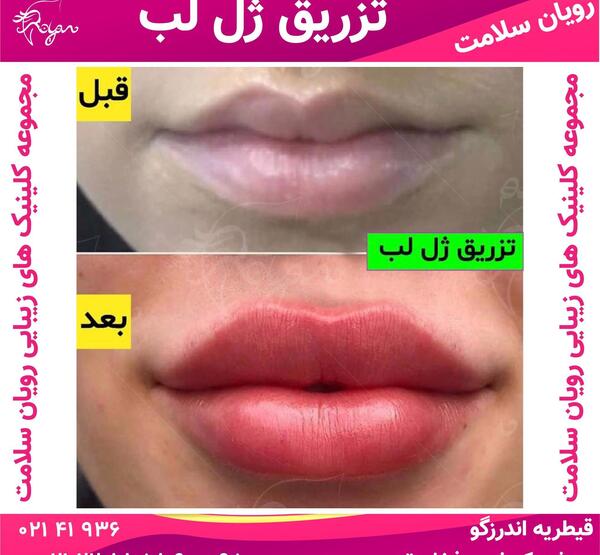 عکس لب پروتز زشت
