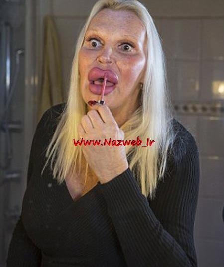 عکس لب پروتز زشت