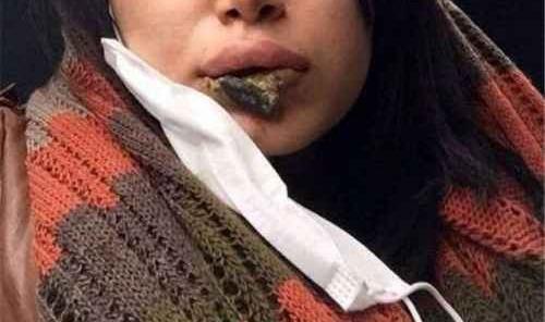 عکس لب پروتز زشت