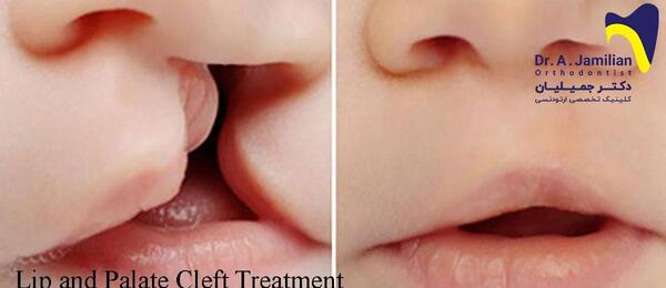 عکس های وحشتناک لب شکری