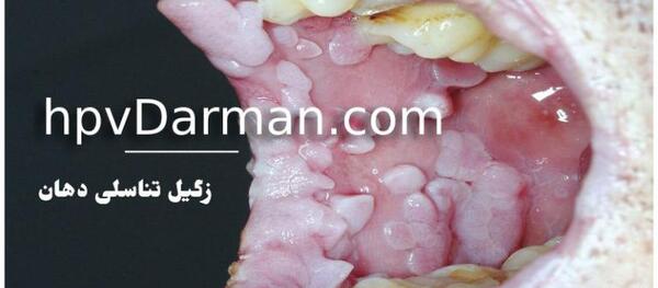 عکس ویروس hpv در مردان