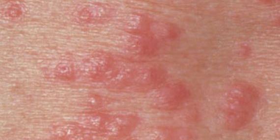 عکس ویروس hpv در مردان
