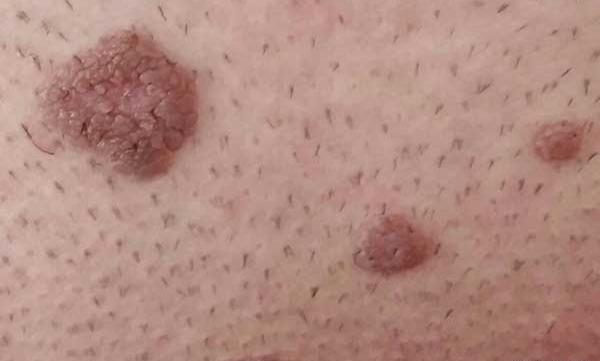عکس ویروس hpv در مردان
