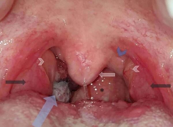 عکس ویروس hpv در مردان