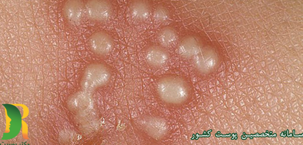 عکس ویروس hpv در مردان