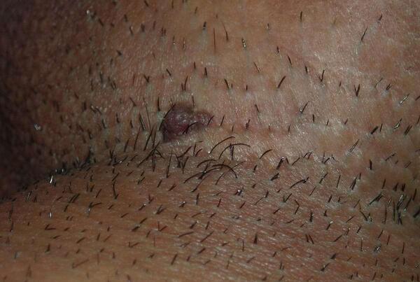 عکس ویروس hpv در مردان