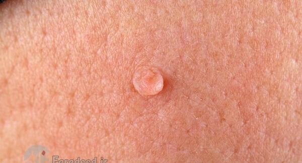 عکس ویروس hpv در مردان