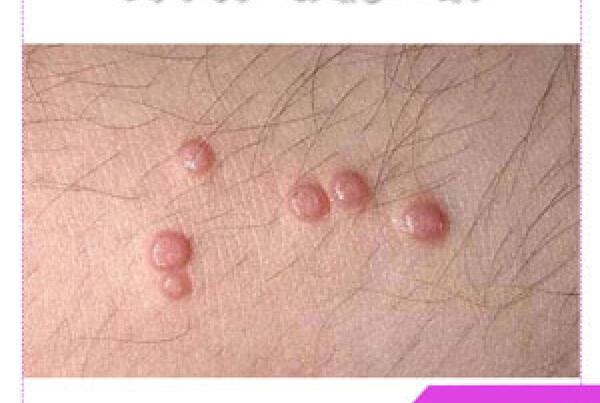 عکس ویروس hpv در مردان
