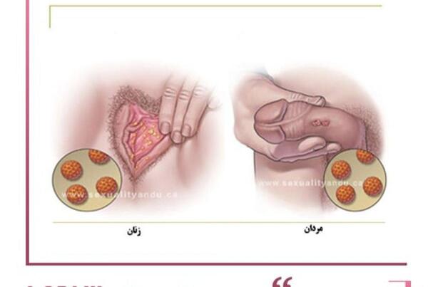 عکس ویروس hpv در مردان