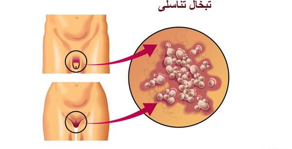 عکس ویروس هرپس