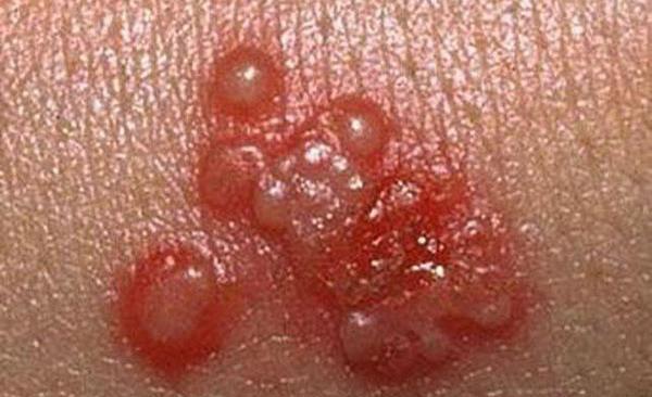 عکس ویروس هرپس