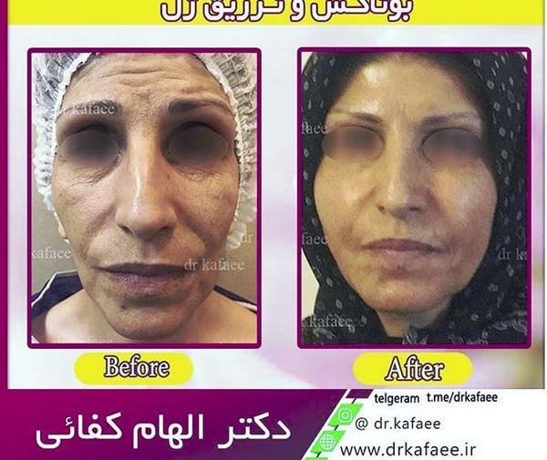 عکس قبل و بعد مزوتراپی صورت