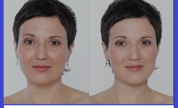 عکس قبل و بعد مزوتراپی صورت