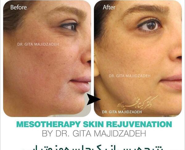 عکس قبل و بعد مزوتراپی صورت