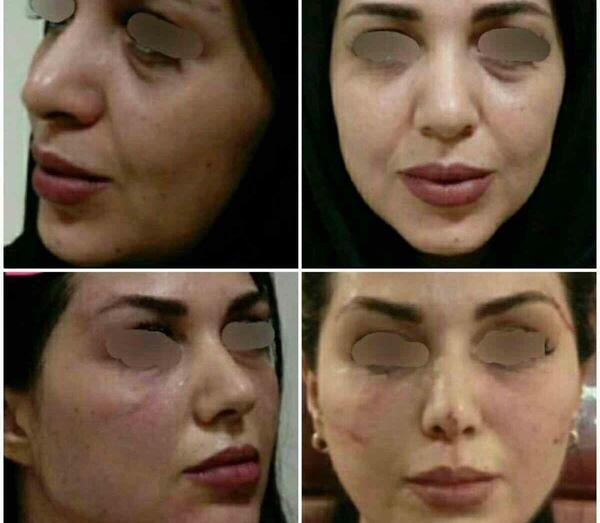 عکس قبل و بعد مزوتراپی صورت