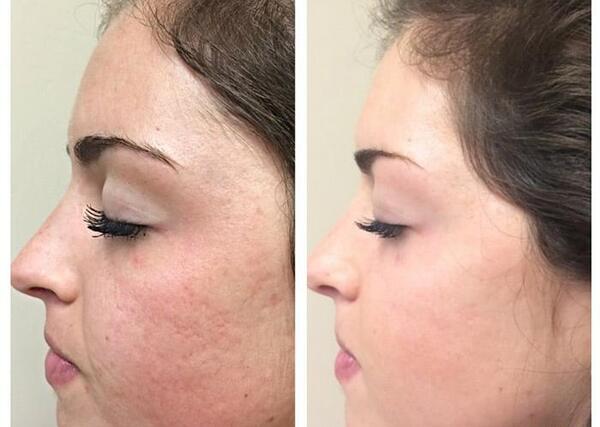 عکس قبل و بعد مزوتراپی صورت
