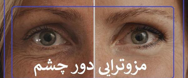 عکس قبل و بعد مزوتراپی صورت