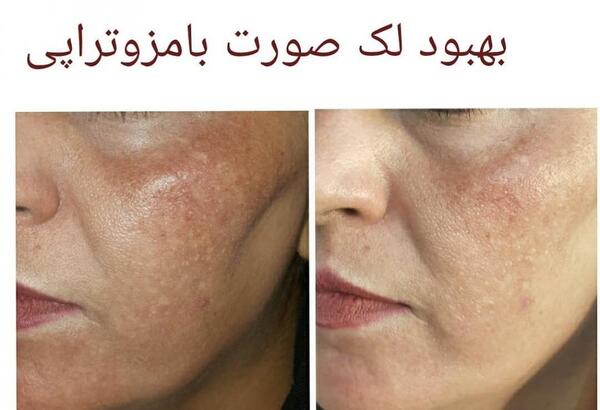 عکس قبل و بعد مزوتراپی صورت