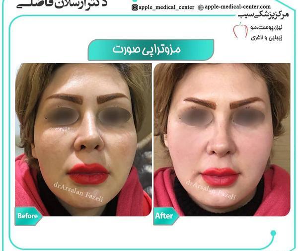 عکس قبل و بعد مزوتراپی صورت