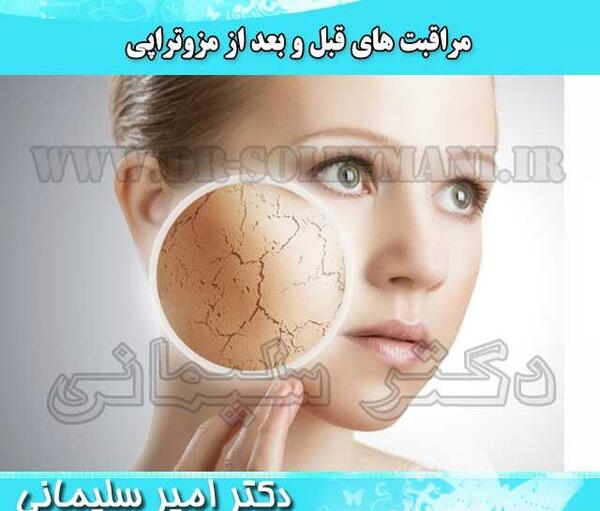 عکس قبل و بعد مزوتراپی صورت