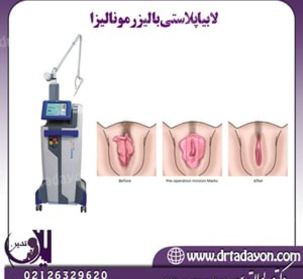 عکس لیزر مونالیزا تاچ