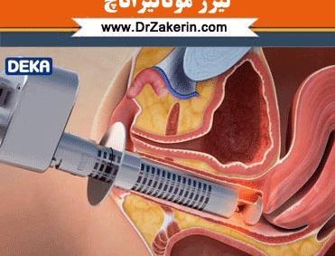 عکس لیزر مونالیزا تاچ