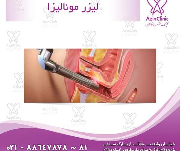 عکس لیزر مونالیزا تاچ