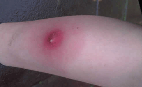 عکس نیش کنه