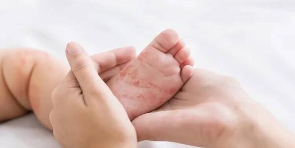 عکس ویروس رزولا