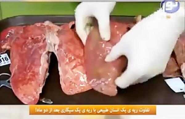 عکس ریه واقعی