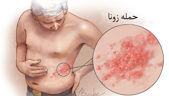 عکس ویروس زونا