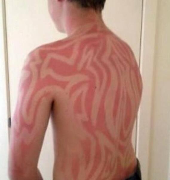 عکس وحشتناک سوختگی صورت