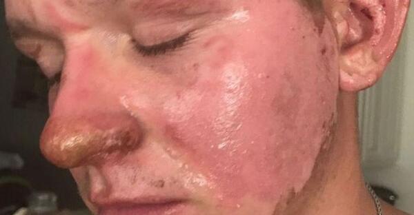 عکس وحشتناک سوختگی صورت