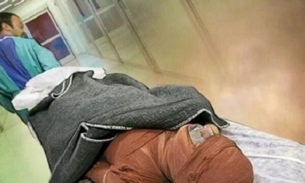 عکس وحشتناک سوختگی صورت