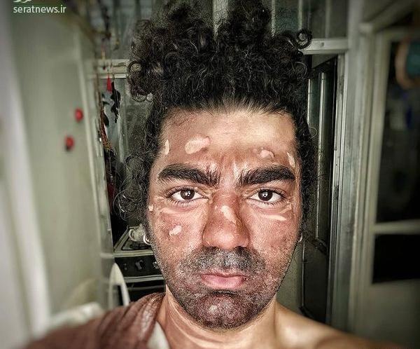 عکس وحشتناک سوختگی صورت