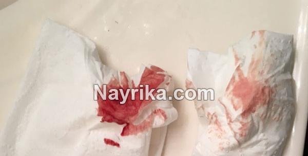 عکس انواع لکه بینی در بارداری