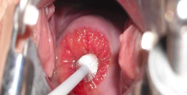 عکس لکه بینی در دوران بارداری
