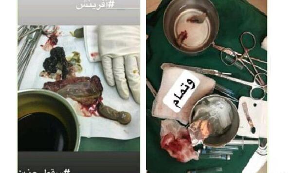 عکس جنین یک ماه سقط شده