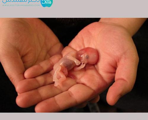 عکس جنین یک ماه سقط شده