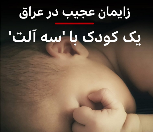 عکس نوزاد عجیب الخلقه در تهران