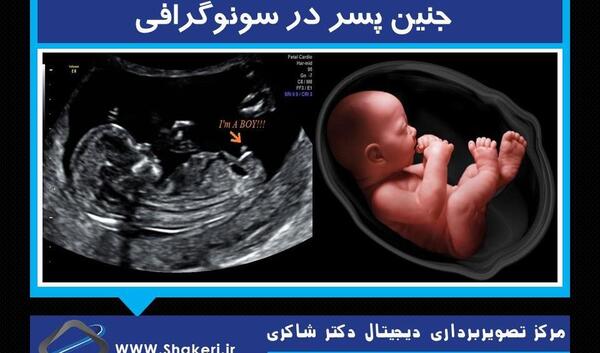 عکس غربالگری نوزاد