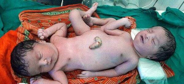 عکس نوزاد ناقص