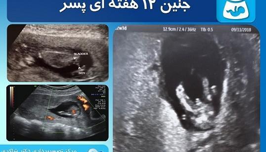 عکس جنین پسر در هفته دوازدهم بارداری