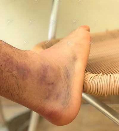 عکس کبودی ساق پا