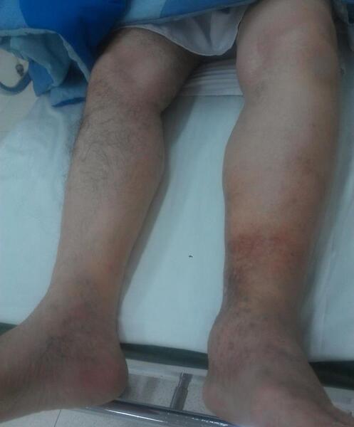 عکس کبودی ساق پا