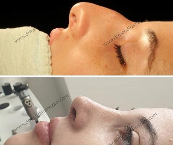 عکس کبودی بعد عمل بینی
