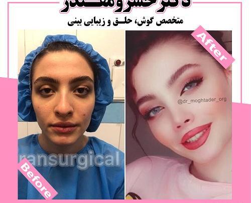 عکس کبودی بعد عمل بینی