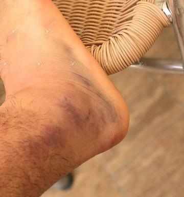 عکس کبودی پشت ساق پا